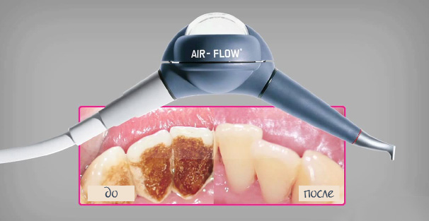 Air Flow чистка и отбеливание зубов