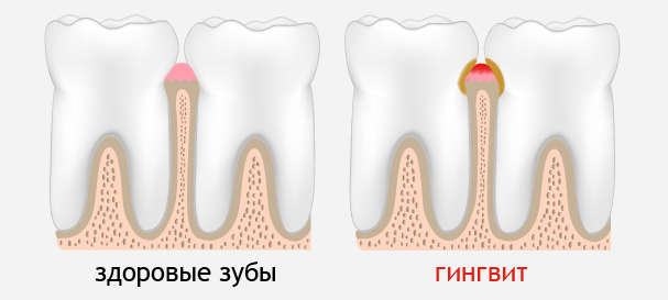 Лечение гингвита
