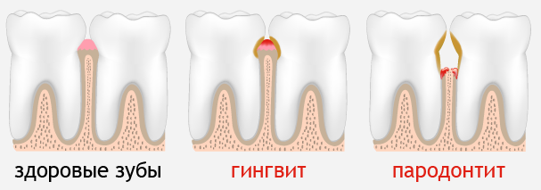 Лечение пародонтита