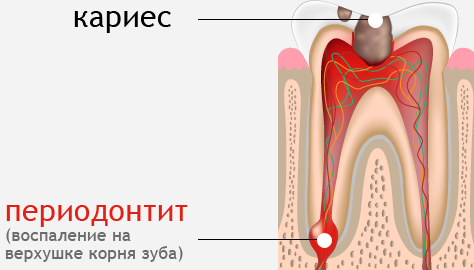Лечение периодонтита