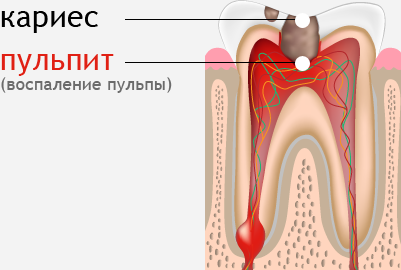 Лечение пульпита