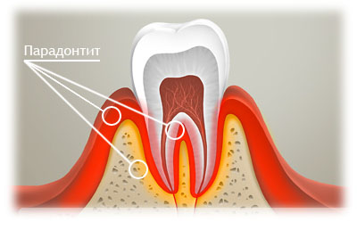 Пародонтит зубов - симптомы