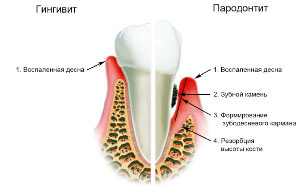 Гингивит и парадонтит лечение