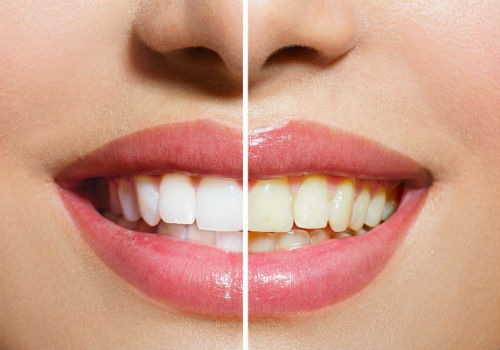 Отбеливание зубов до и после фото