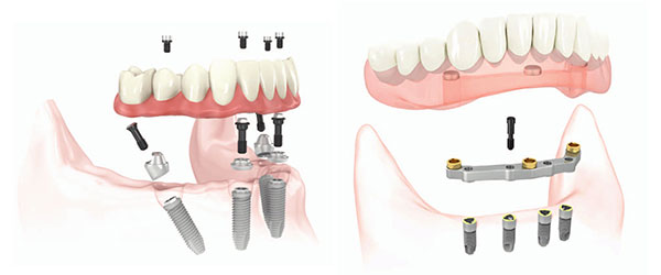 Протезирование зубов One-on-4