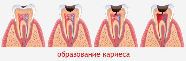 Этапы образования кариеса на зубе
