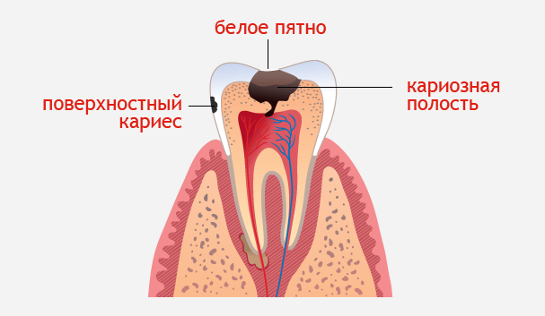 Лечение кариеса в Петербурге (Спб)