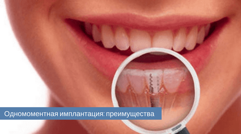 одномоментная имплантация.png