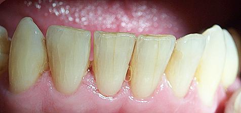 Как сохранить потрескавшийся зуб
