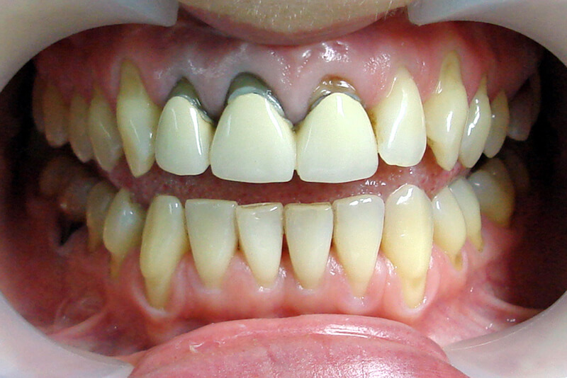 протезирование передних зубов.jpg