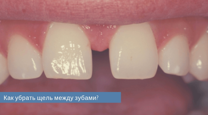 Как убрать щель между зубами