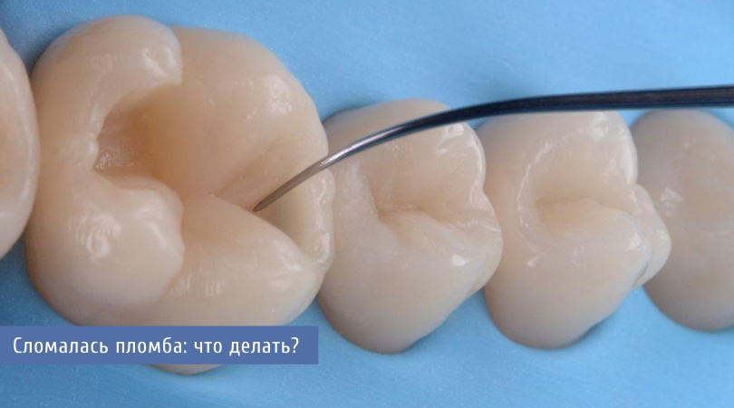 Дефекты пломбы: какие они бывают, и чем это грозит?