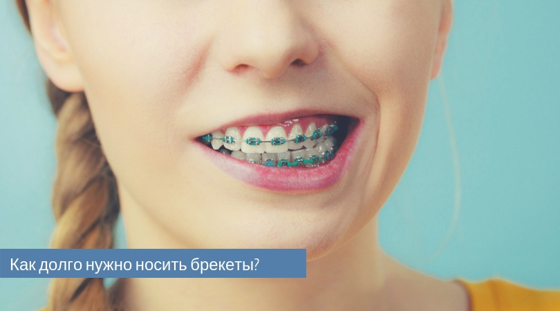 Почему люди носят брекеты дольше положенного срока: основные причины