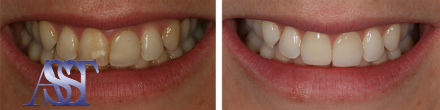 Отбеливание зубов в Ас-Стом