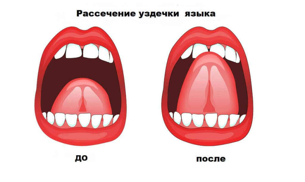 френулопластика в ас-стом.jpg