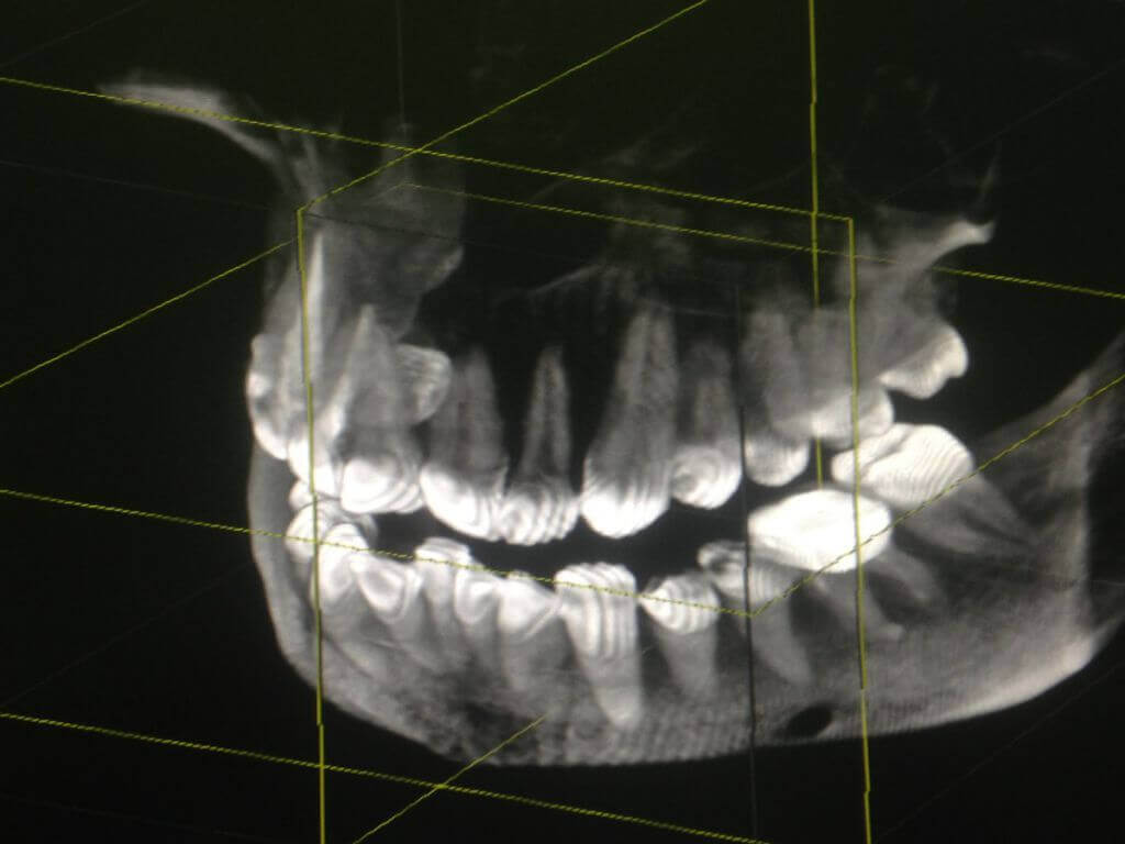 томография челюсти.jpg