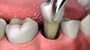 Что нужно знать перед удалением зуба