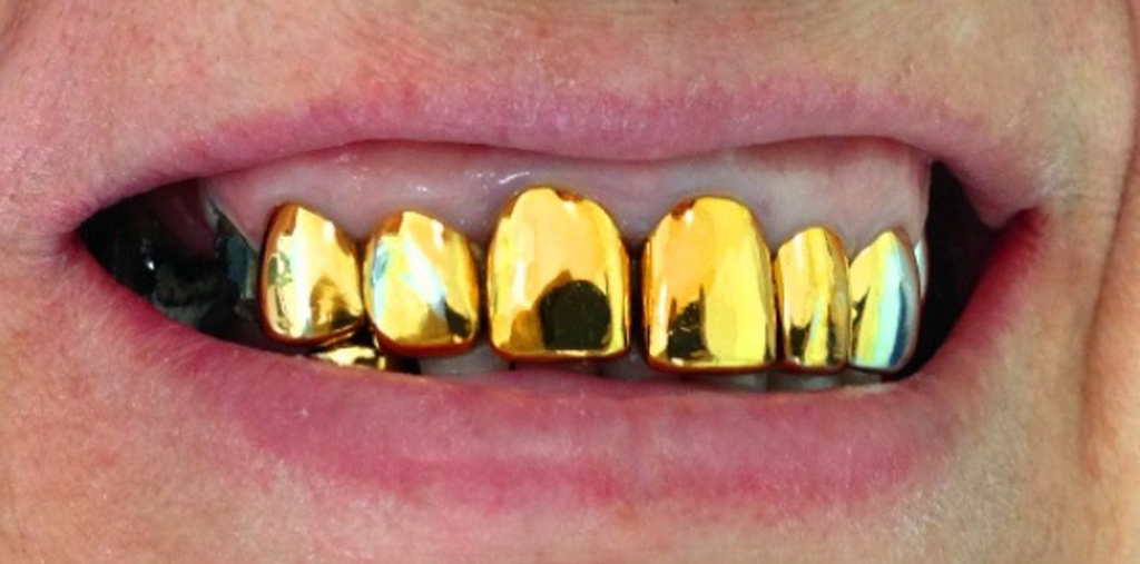 Металлические коронки на зубы