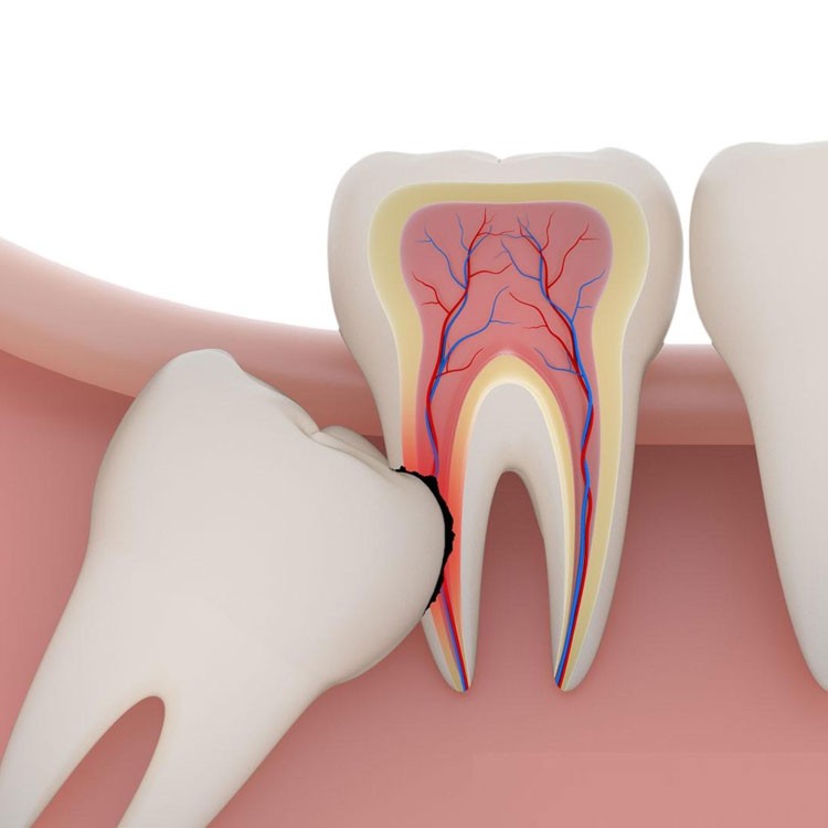 Ретинированный зуб