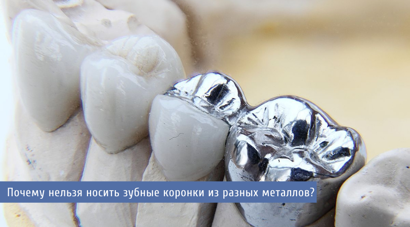 Коронки из разных металлов