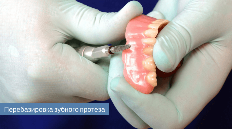 Перебазировка съемного зубного протеза