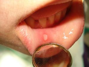 Проявление язвы желудка в полости рта