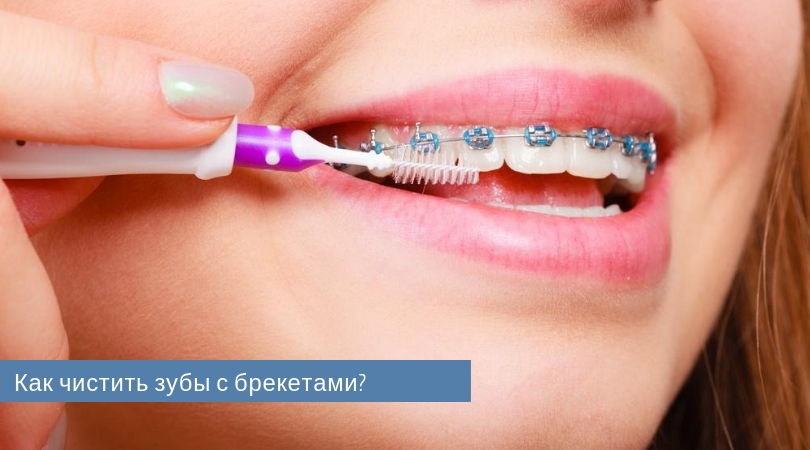 Чистка зубов с брекетами