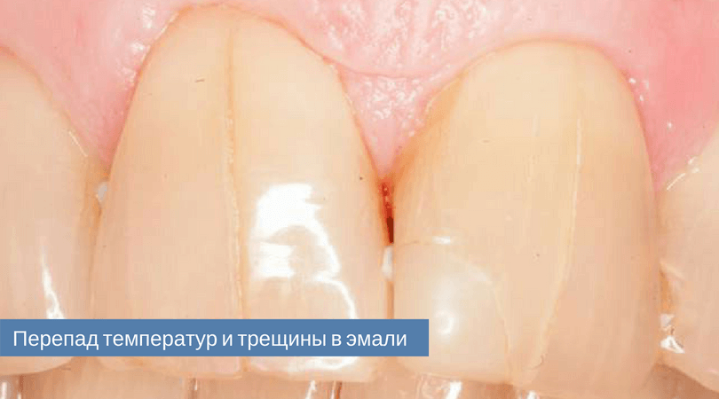 Трещины на зубах