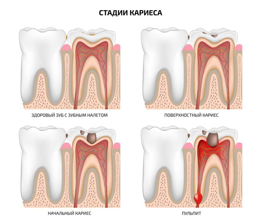 Стадии развития кариеса фото