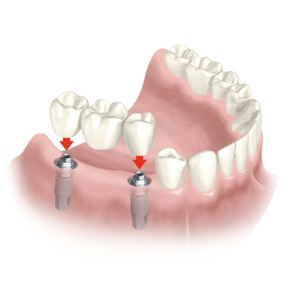 Как выглядят мосты в стоматологии