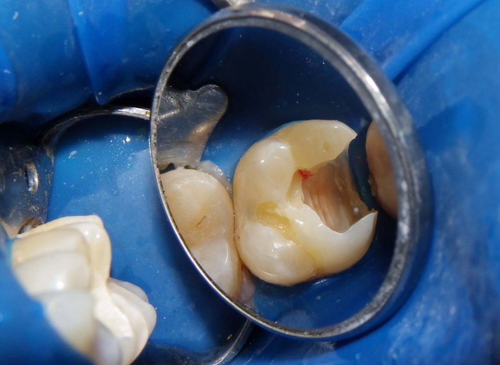 Почему удаляют нерв в зубе