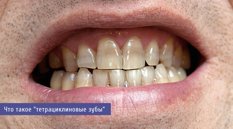 отбеливание тетрациклиновых зубов