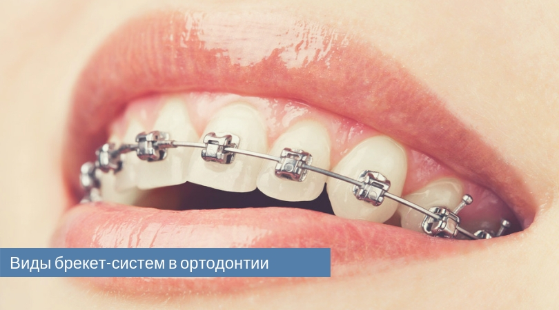 прозрачные брекеты.jpg
