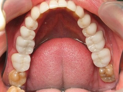 Протезирование задних зубов
