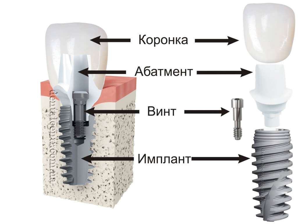 абатмент.jpg