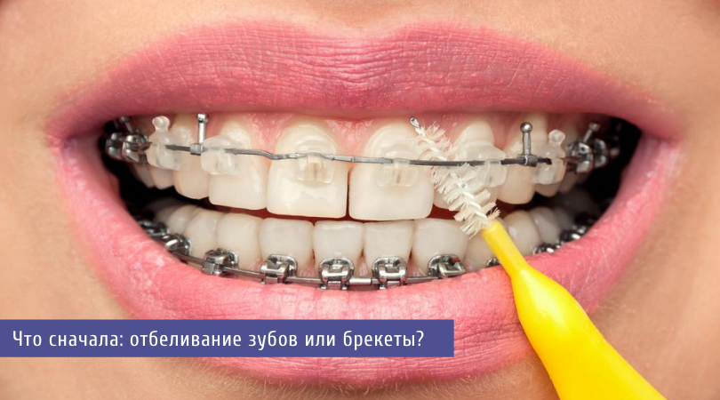 отбеливание зубов и брекеты.png