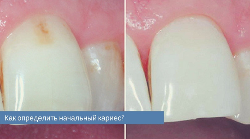 начальный кариес.jpg