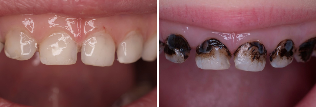 серебрение зубов у детей1.jpg