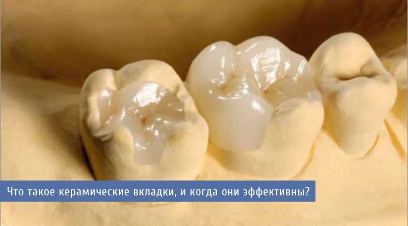 Что такое керамические вкладки