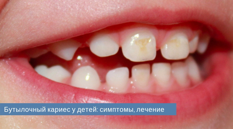 Бутылочный кариес у детей