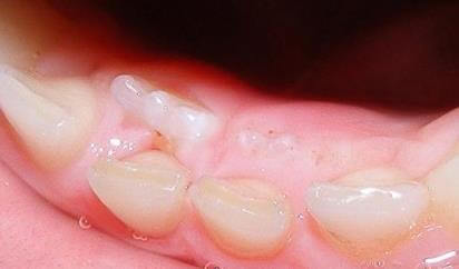 Коренные зубы меняются или нет