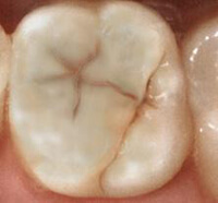 Лечение расколотого зуба
