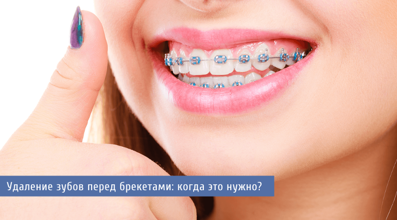 удаление зубов перед брекетами.png