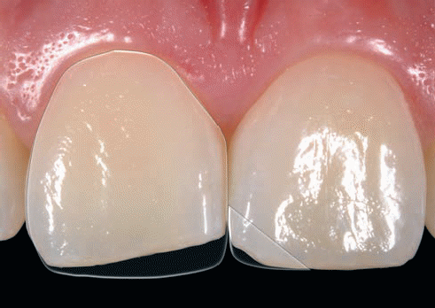 Исправление зубов разной длины