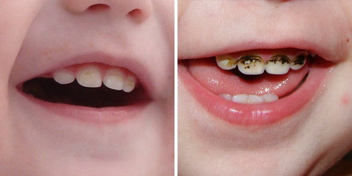 серебрение зубов у детей.jpg