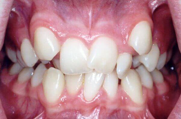 Виды дистопии зубов